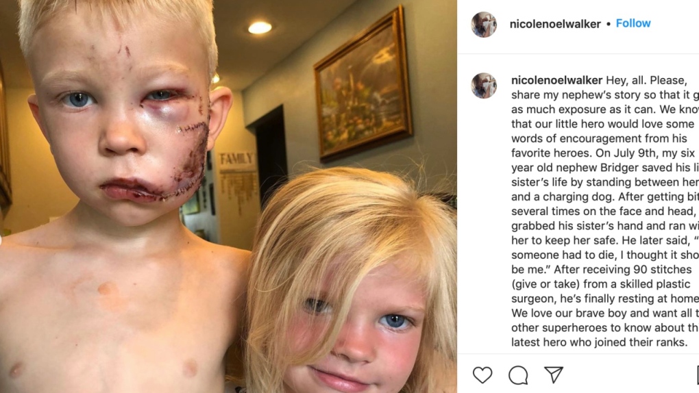 Boy gets 90 stitches after saving little sister from dog attack ...