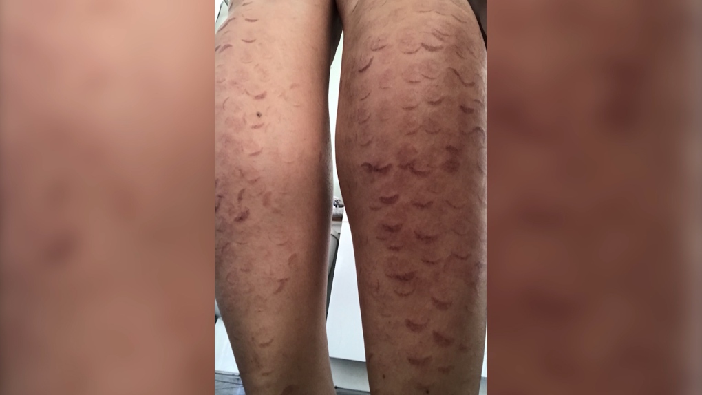 Laser hair removal left exotic dancer with unsightly marks, lawsuit alleges  | CTV News
